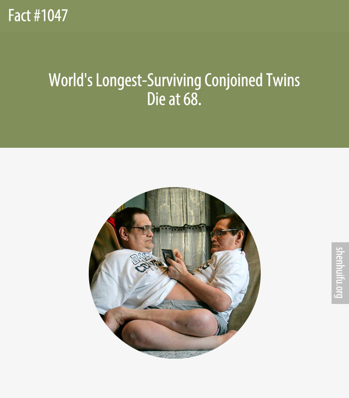 World's Longest-Surviving Conjoined Twins Die at 68