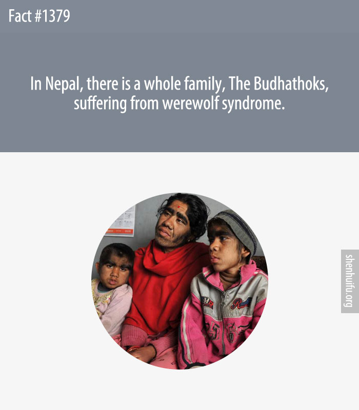 In Nepal, there is a whole family, The Budhathoks, suffering from werewolf syndrome.