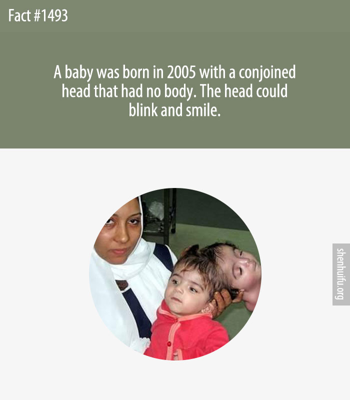 A baby was born in 2005 with a conjoined head that had no body. The head could blink and smile.